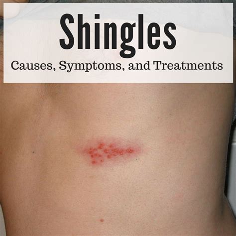 armpit shingles|how to identify shingles.